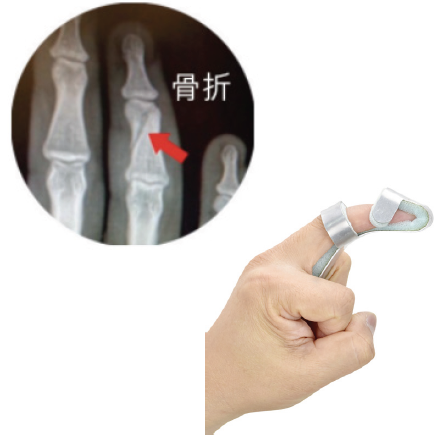 Baseball splint flow image